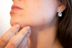 5 Reasons You Still Get Acne In Your 30s Spring Street Dermatology