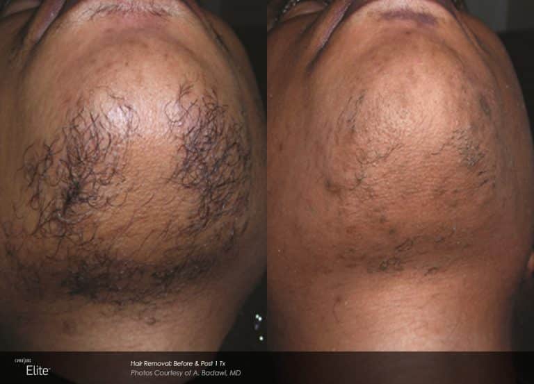 Laser hair removal to treat skin under the chin