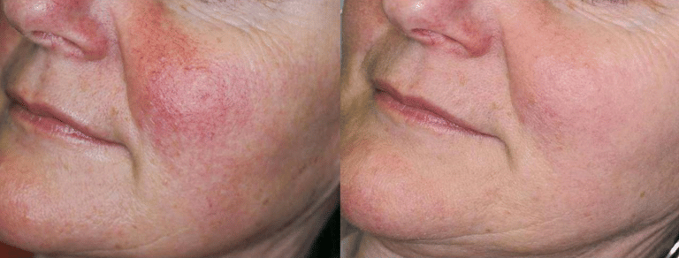 Facial to treat skin redness