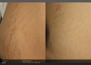 stretch mark before and after treatment results in NY, NY