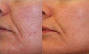 before and after results from medical dermatology treatment to shrink pores in NYC