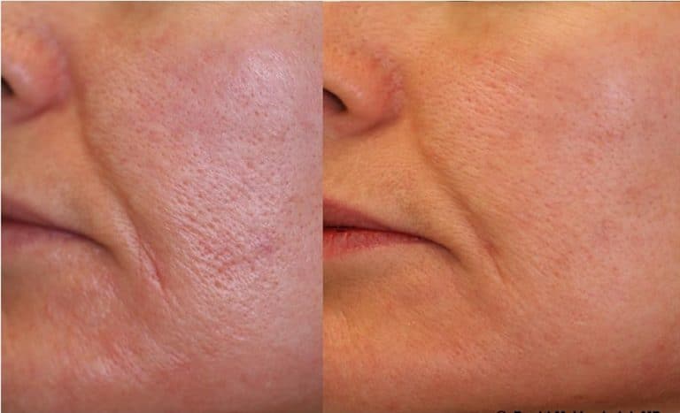 Aesthetic treatment to reduce pore size