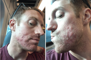 patient selfie of his acne 
