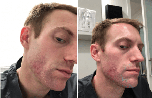 accutane before and during treatment results in NYC