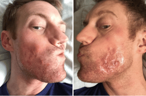 acne patient selfie from NYC