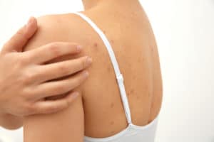 back acne treatment in new york