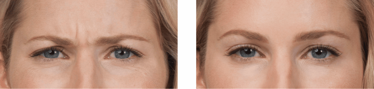 Botox to treat glabellar lines between the eyebrows