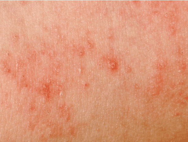Common types of rashes