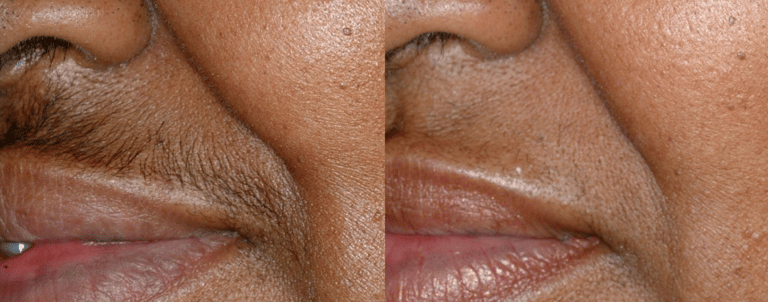 Laser hair removal for hair above upper lip
