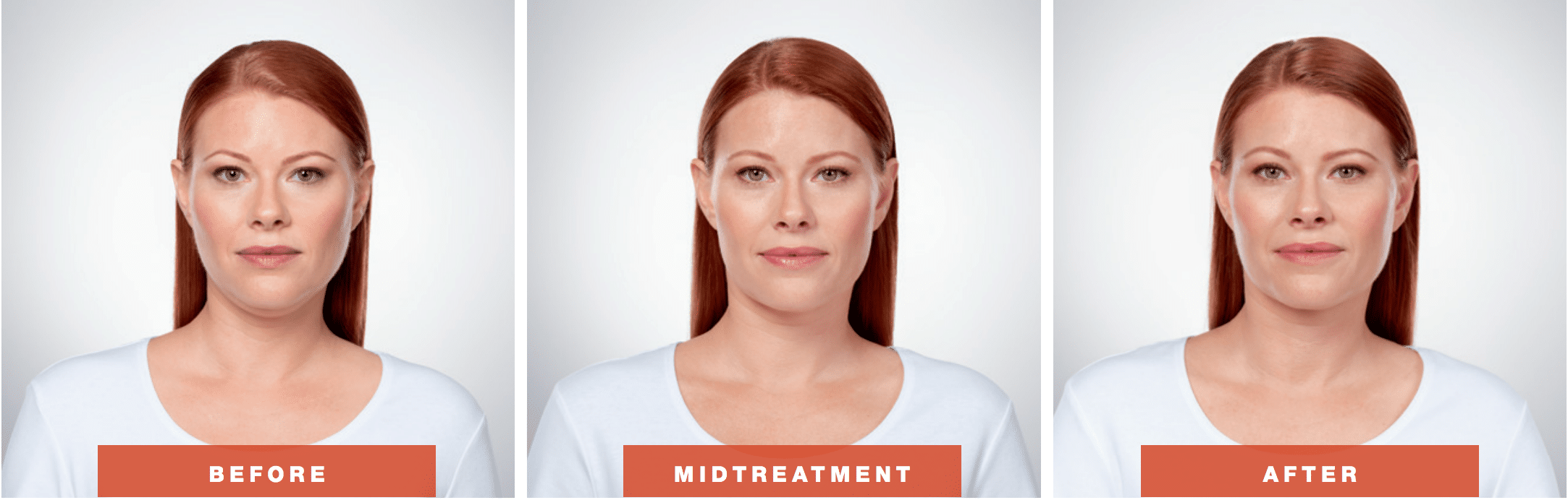 kybella double chin treatment in new york