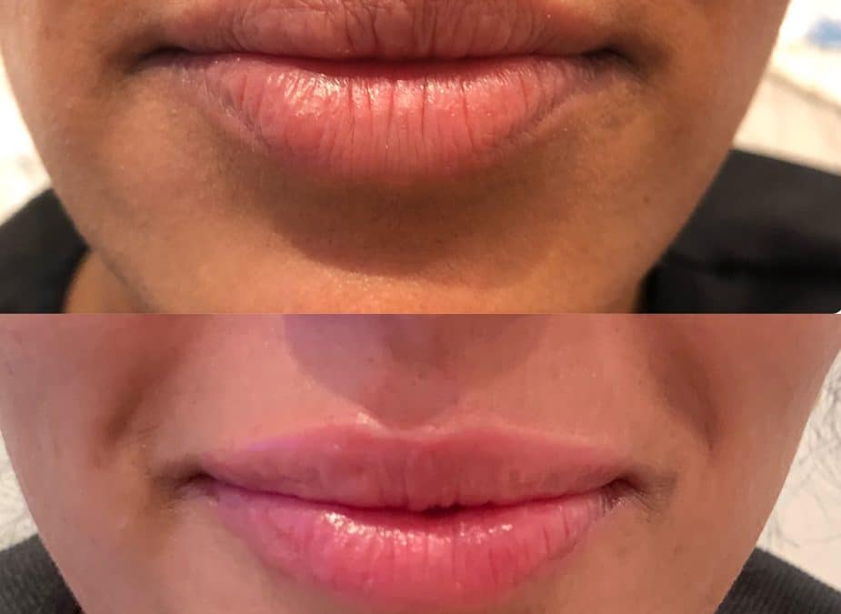 lip filler before and after image