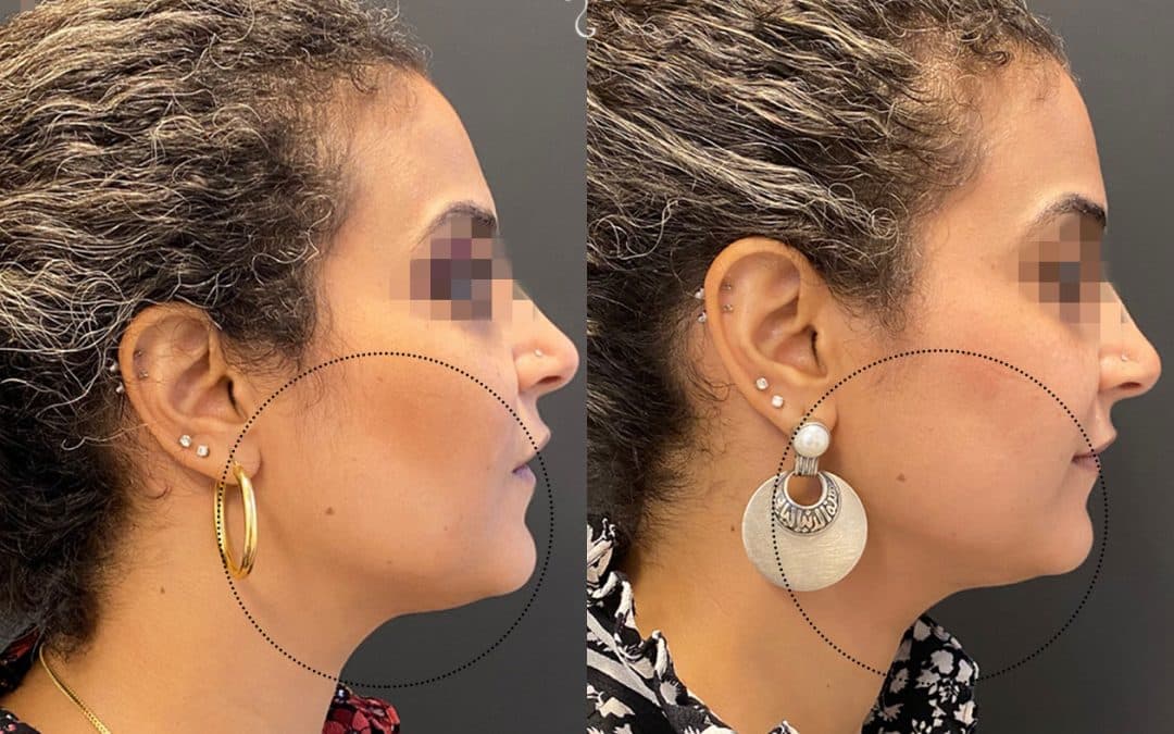 Ultherapy skin tightening procedure in New York before and after image