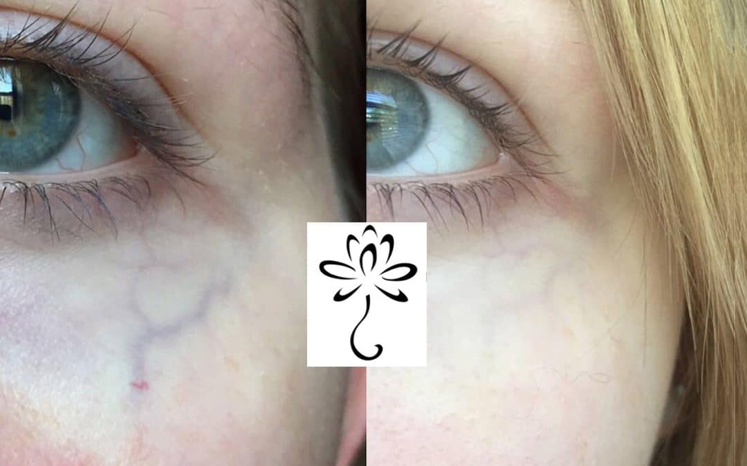 laser treatment rejuvenates under-eye veins