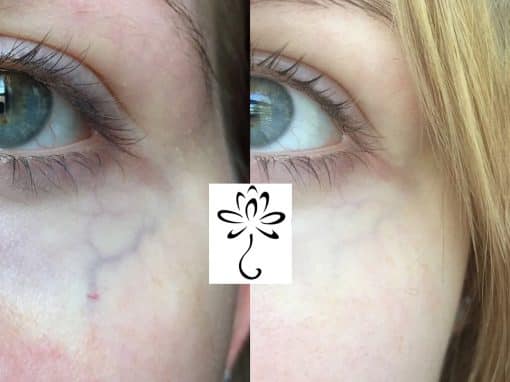 Laser Treatment to Remove Vein Under the Eye