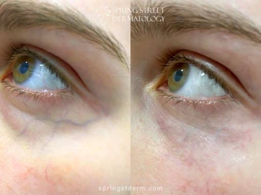 Excel V laser to remove vein under eye