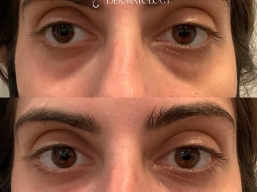 Restylane Refyne fillers to treat wrinkles under the eyes