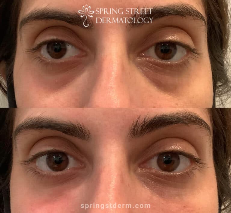Restylane Refyne fillers to treat wrinkles under the eyes