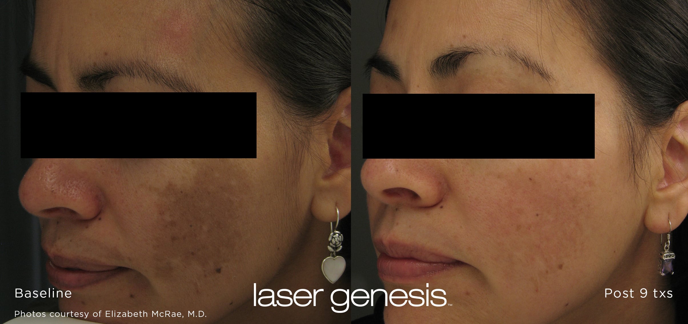 Laser Genesis to treat hyperpigmentation treatment results in New York City