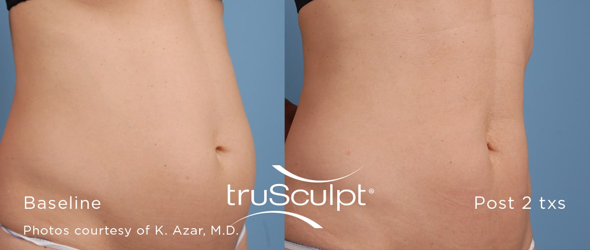 truSculpt body sculpting results in New York City