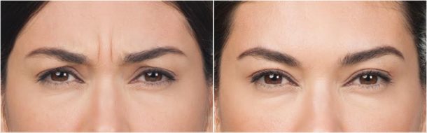 before and after results from Botox Cosmetic in NYC