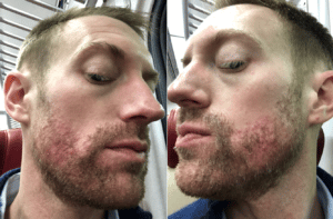 acne treatment before and after results in NYC