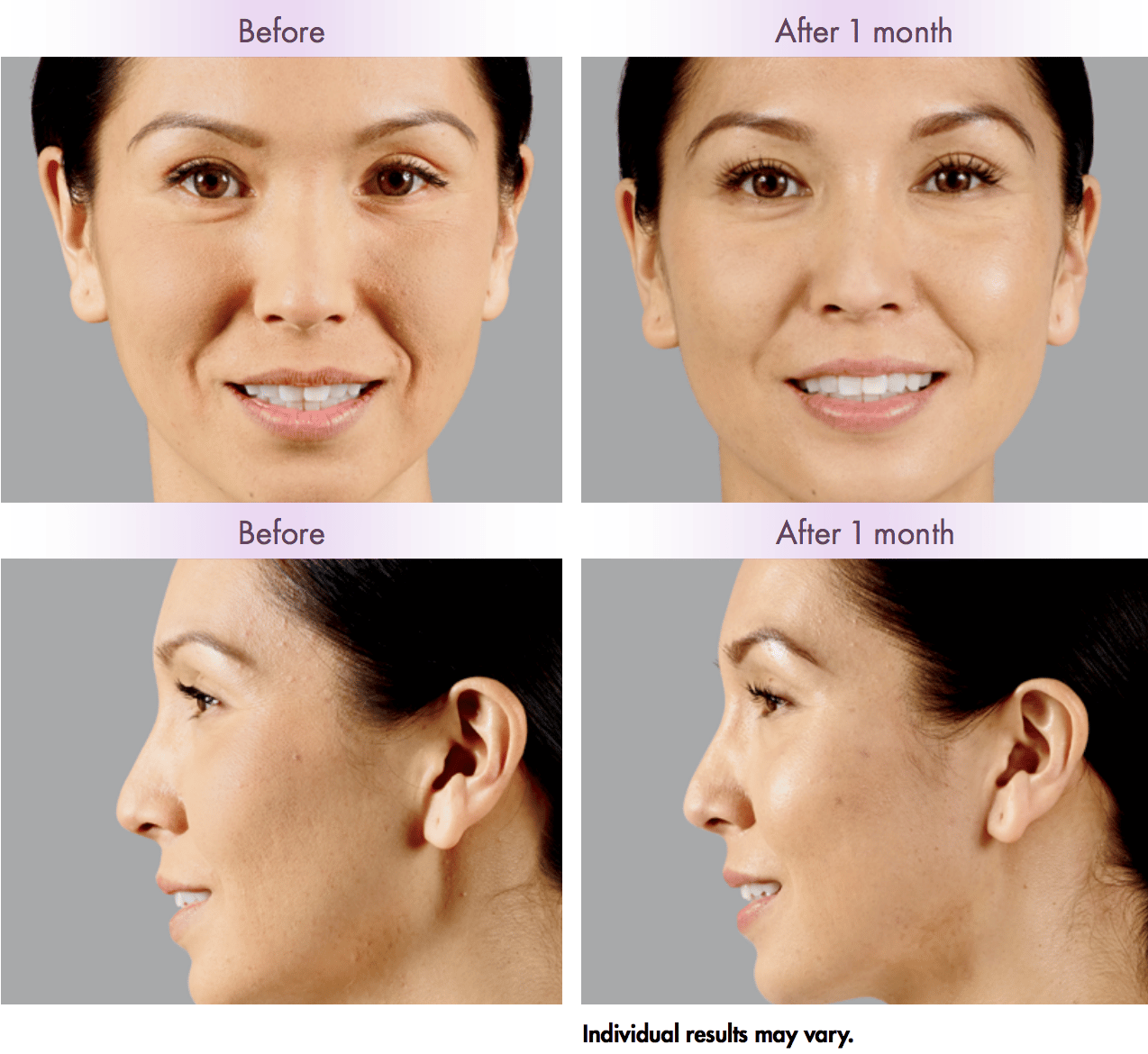 before and after results from dermal filler injections in NYC, NY