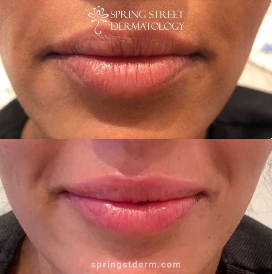 before and after results from a dermal filler treatment in NYC for lip augmentation 