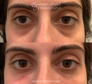 facial fillers before and after results in NYC