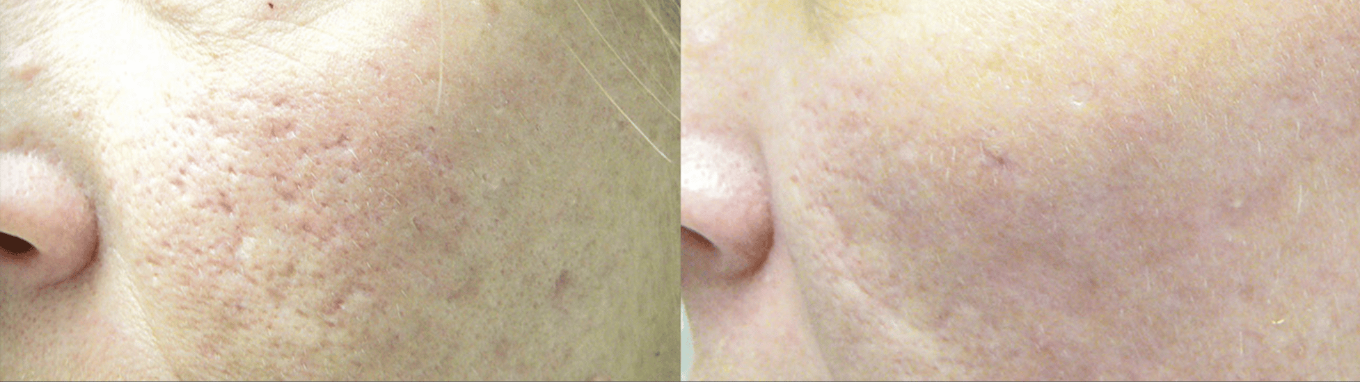 laser resurfacing before and after results in NYC
