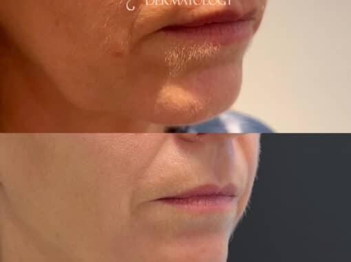Agnes Radiofrequency (RF) to Treat Jowls