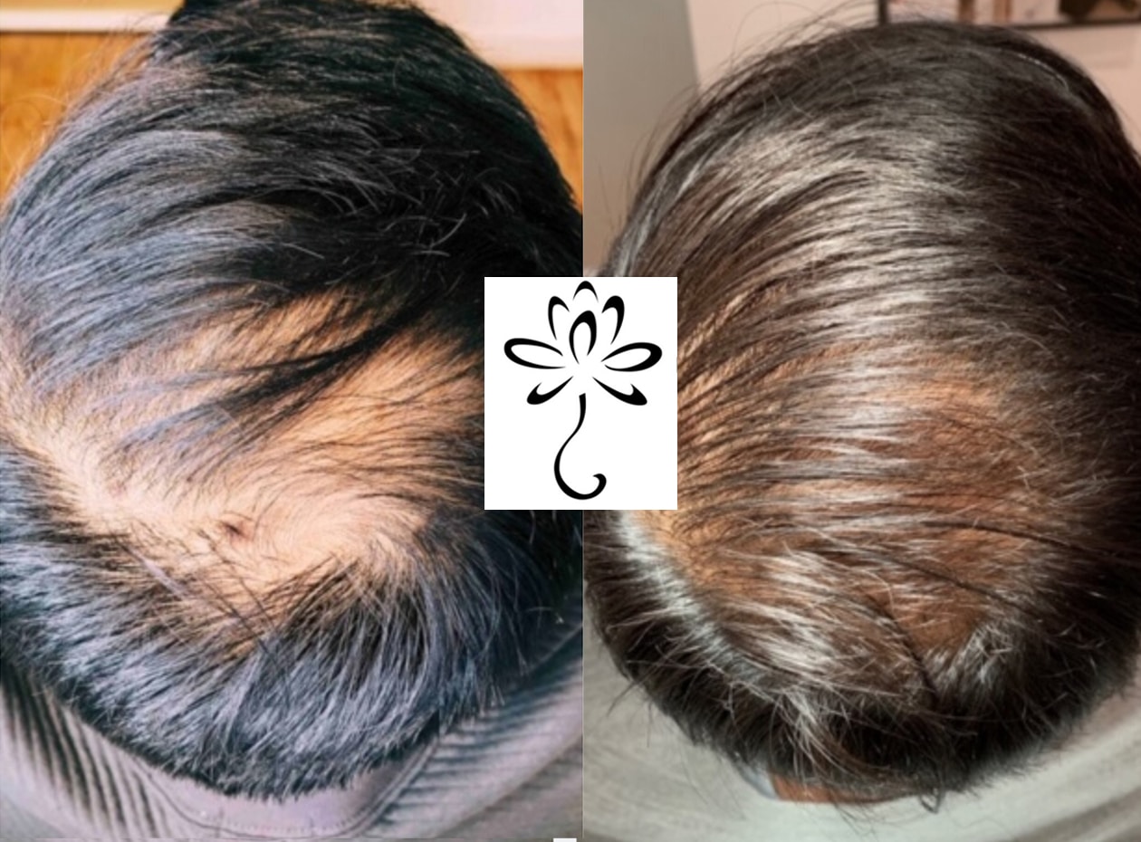 Hair Loss Treatment New York, NY | Spring Street Dermatology