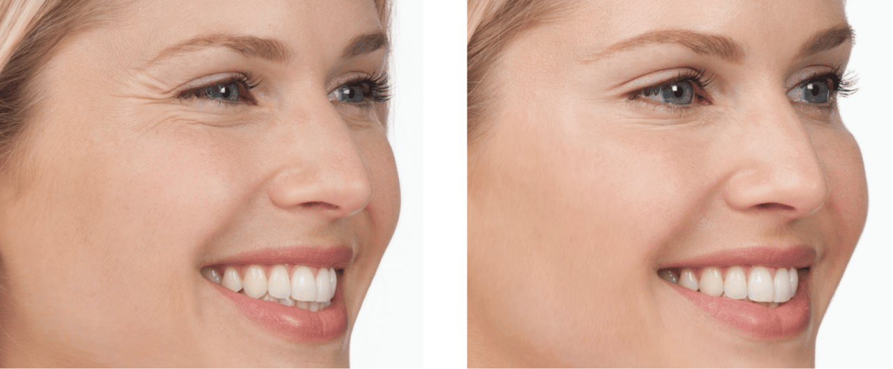 Botox for Crow's Feet Spring Street Dermatology