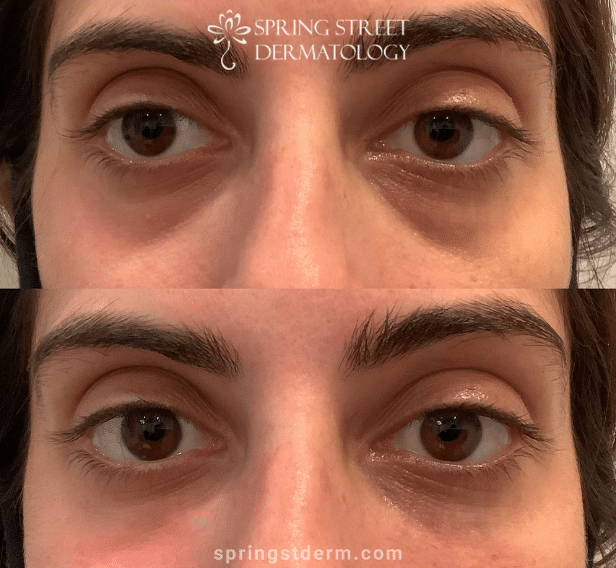 spring street dermatology before and after fillers new york city ny