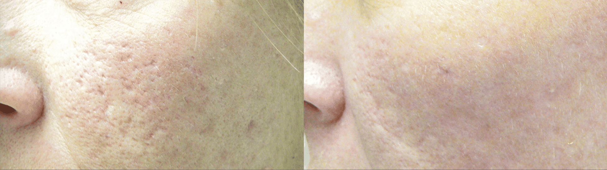 spring street dermatology secret RF before and after new york city ny